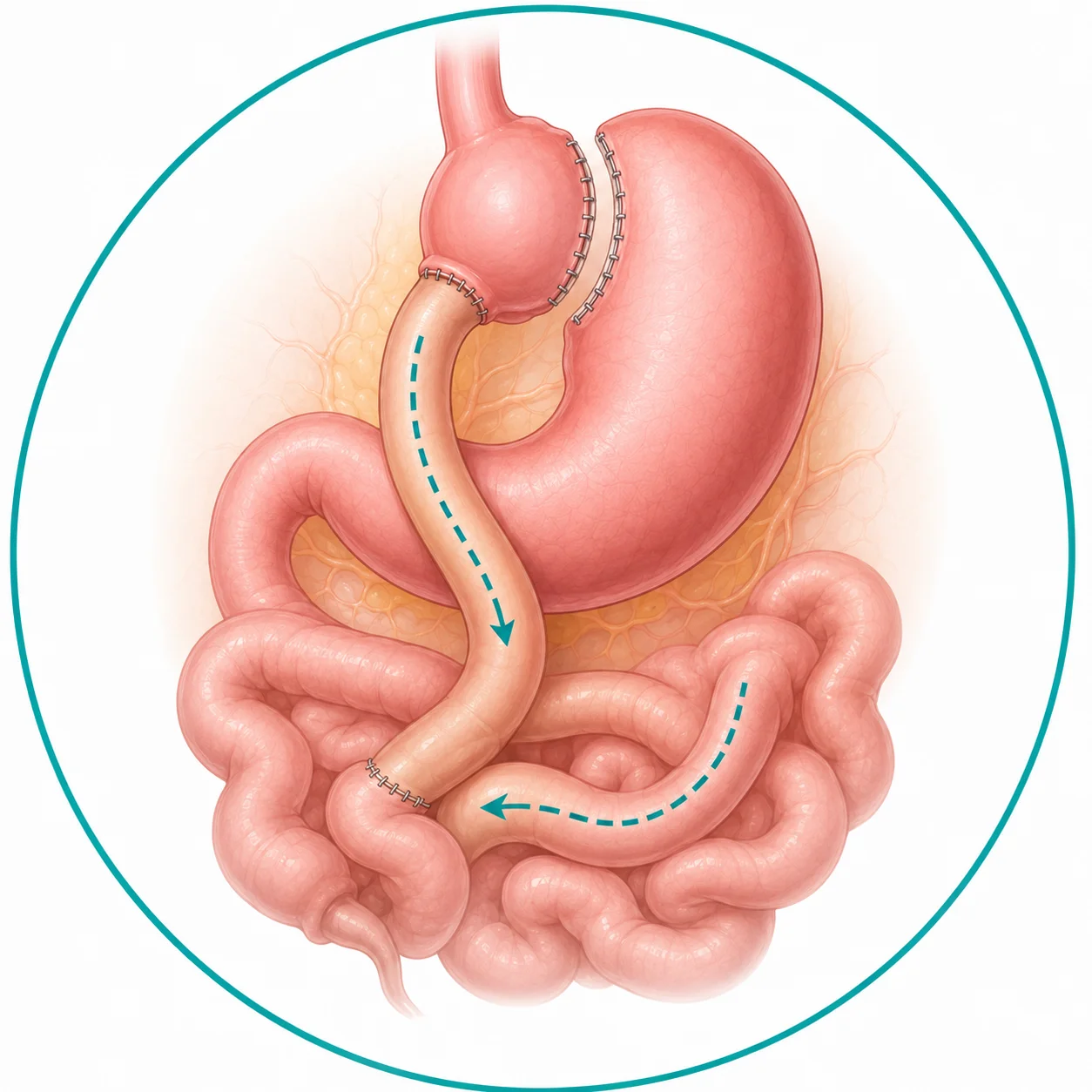 Illustration of Roux-en-Y Gastric Bypass showing the small stomach pouch and rerouted intestine