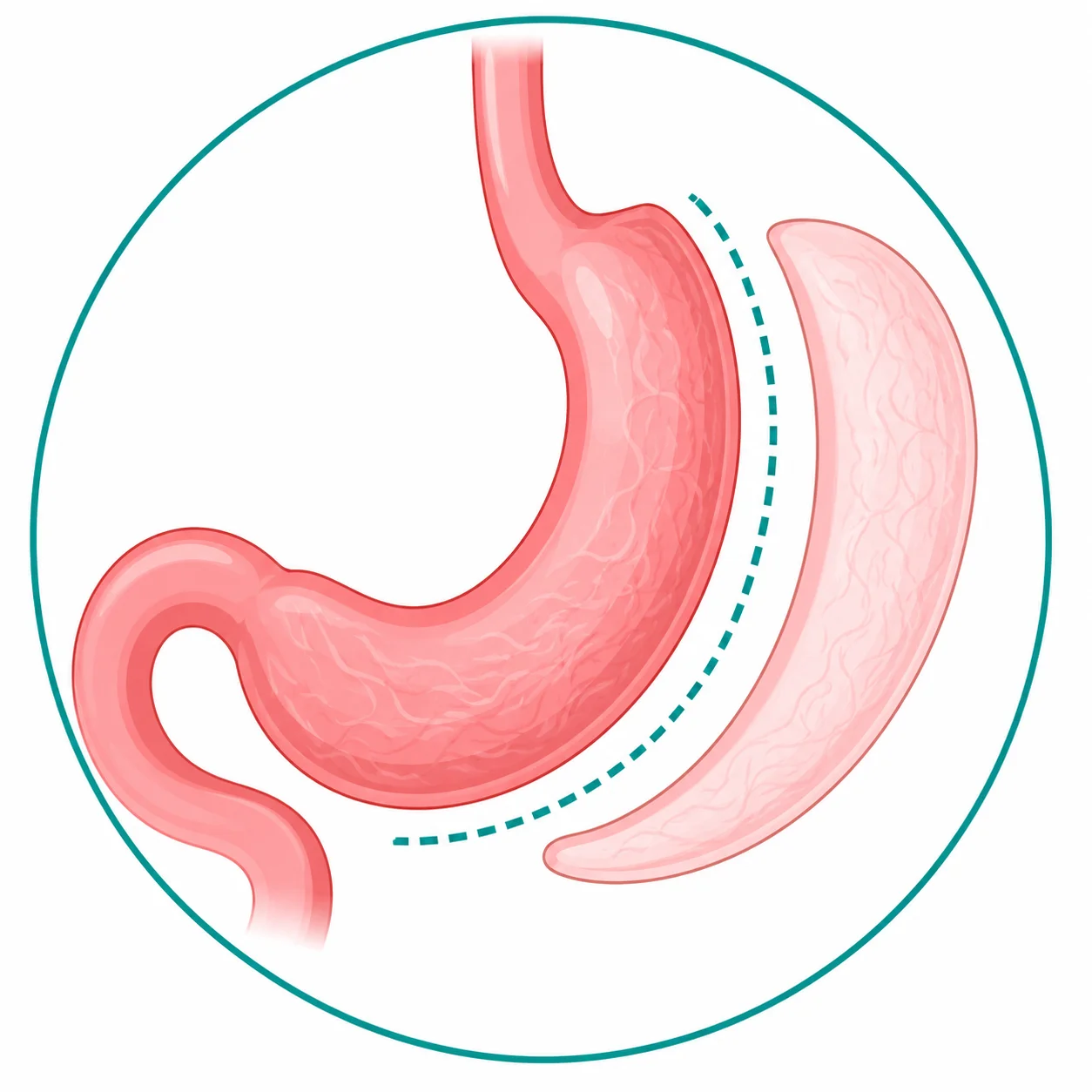 Illustration of Sleeve Gastrectomy showing the portion of the stomach removed during surgery