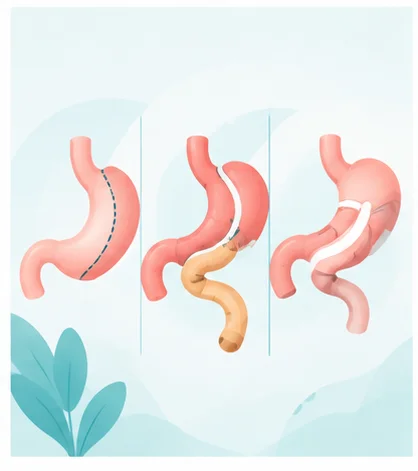 Illustration comparing Sleeve Gastrectomy, Mini Gastric Bypass and Roux-en-Y Gastric Bypass procedures